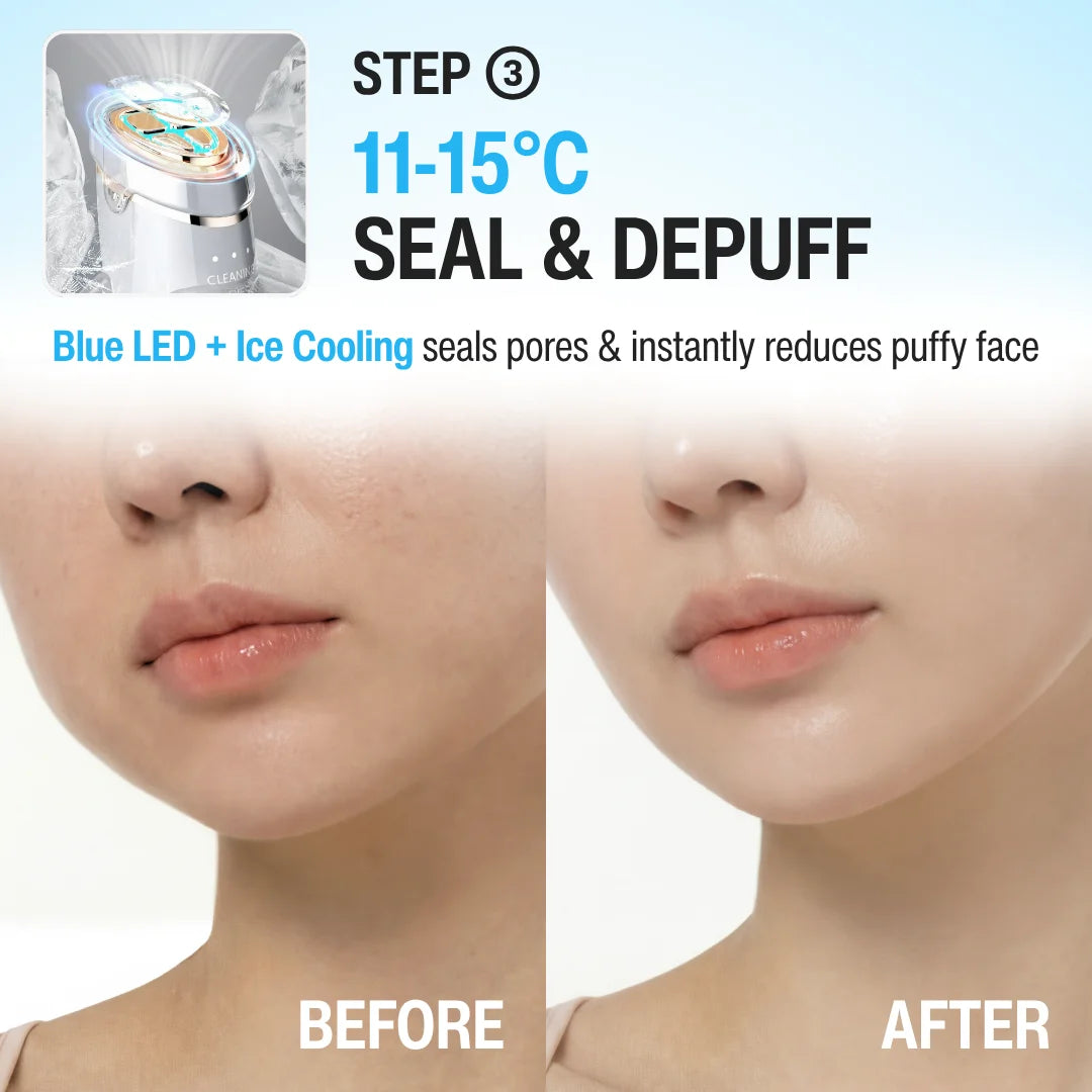 CRYO THERMAL PRO DEVICE